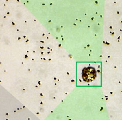 Détection innovante et sensible d’une lignée cellulaire cancéreuse à l’aide d’un prototype de biopuce basé sur un capteur GMR à des fins diagnostiques